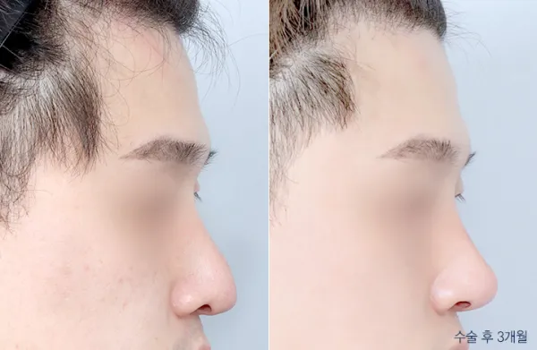 Before/After