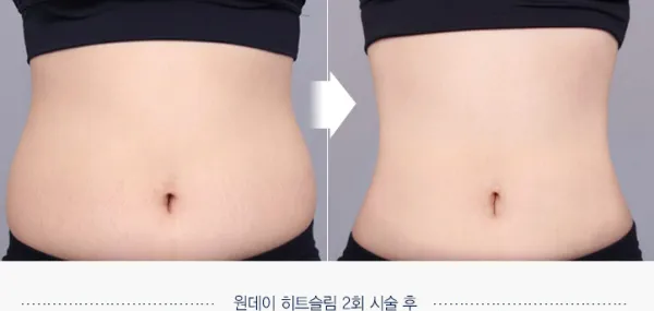 Before/After