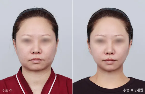 Before/After