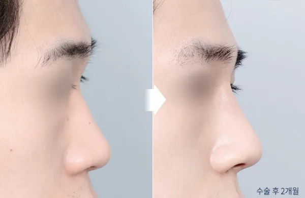 Before/After