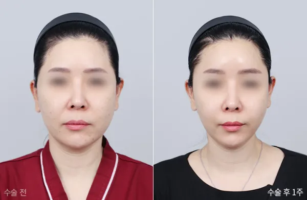 Before/After