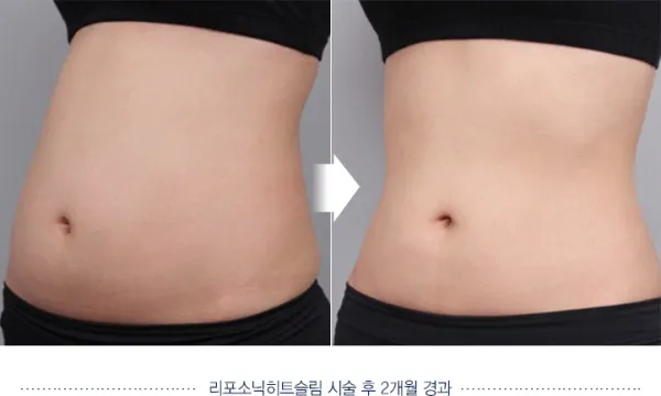 Before/After