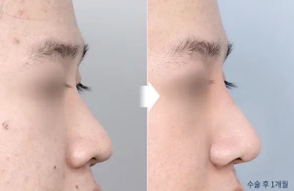 Before/After