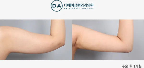 Before/After