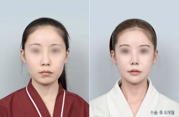 Before/After