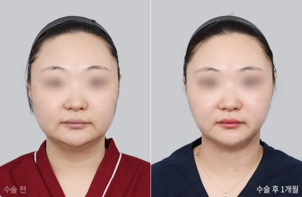 Before/After