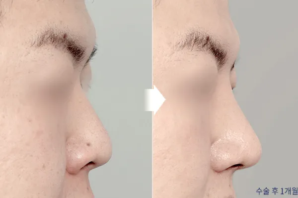Before/After