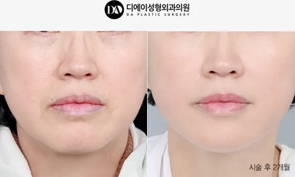 Before/After