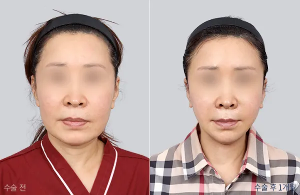Before/After