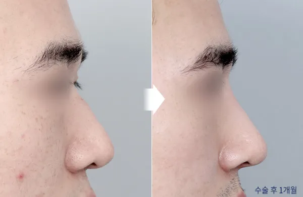 Before/After