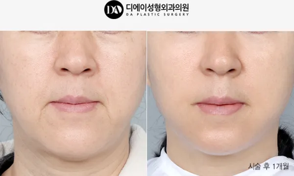 Before/After