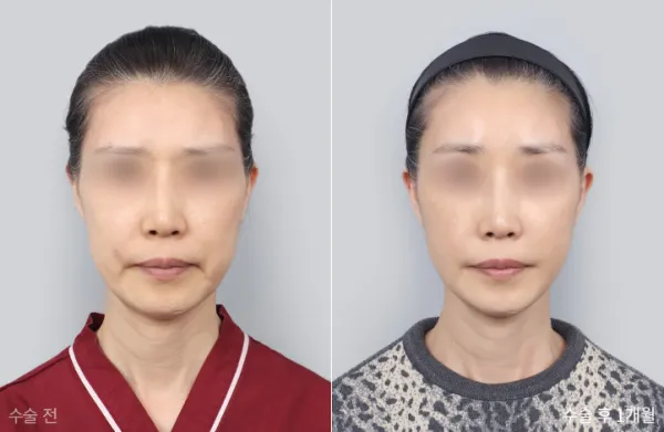 Before/After