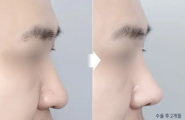 Before/After