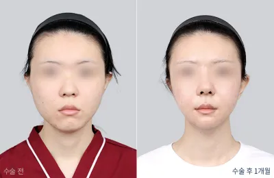 Before & After