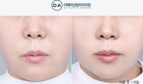 Before/After