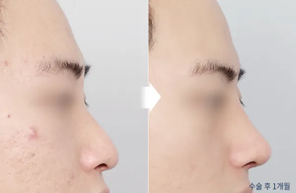 Before/After