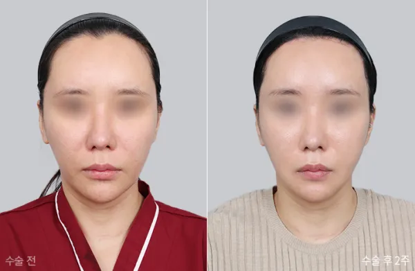 Before/After