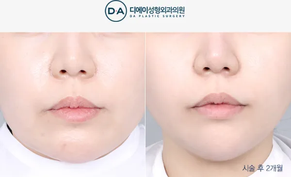 Before/After