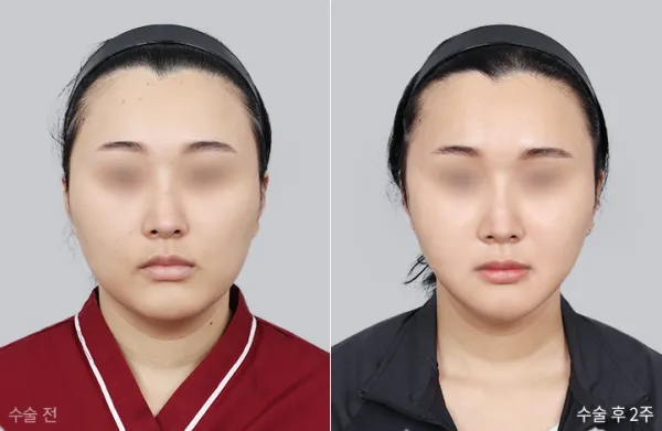 Before/After