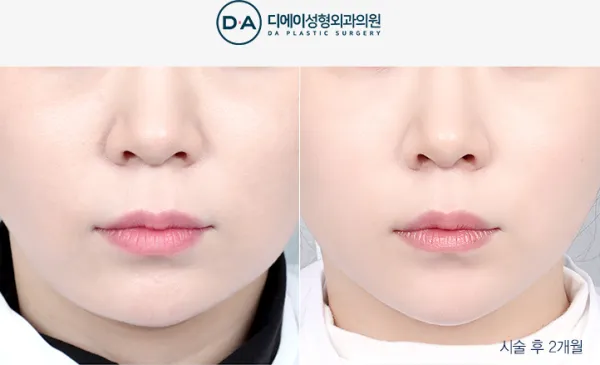 Before/After