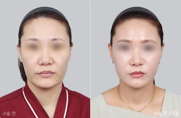 Before/After