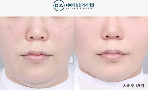 Before/After