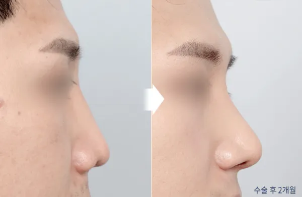 Before/After