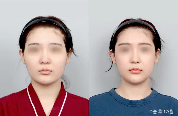Before/After