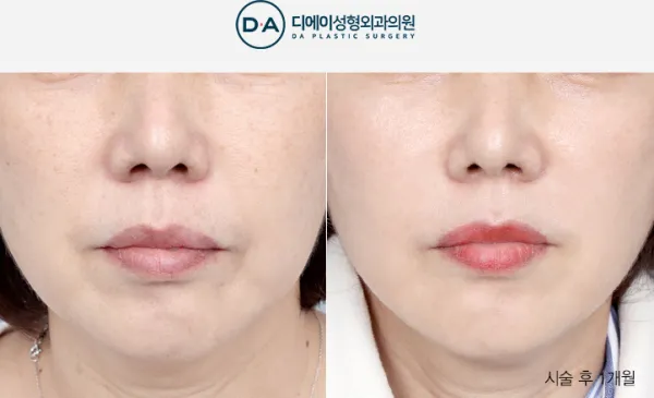 Before/After