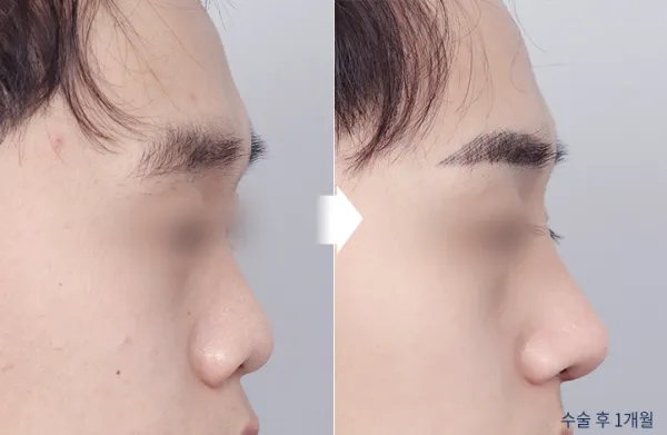 Before/After