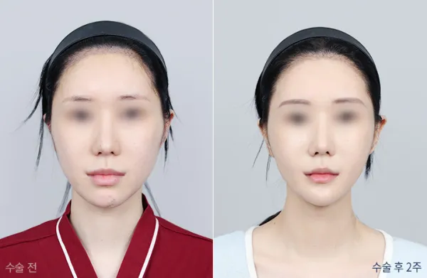 Before/After