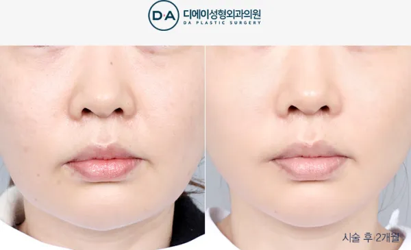 Before/After
