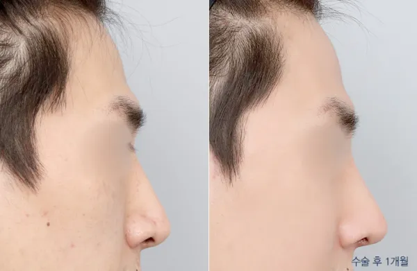Before/After