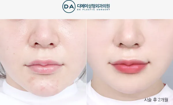 Before/After