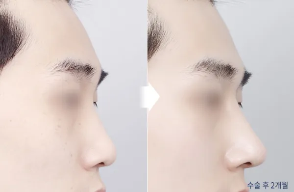 Before/After