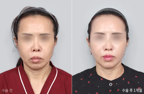 Before/After