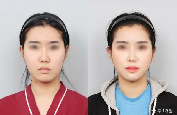 Before/After