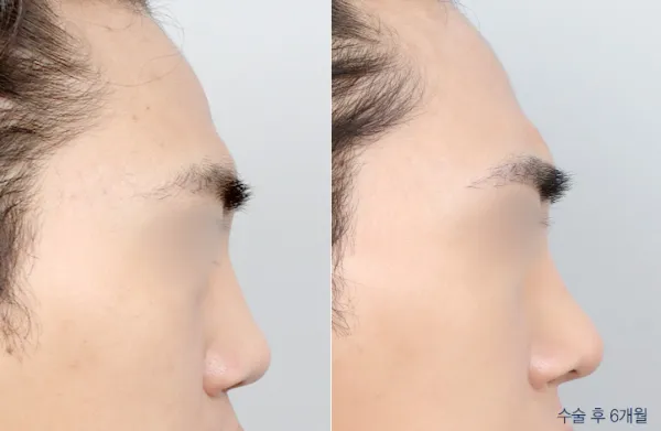 Before/After