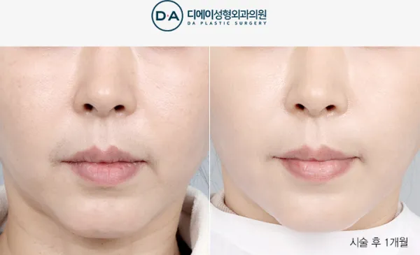Before/After
