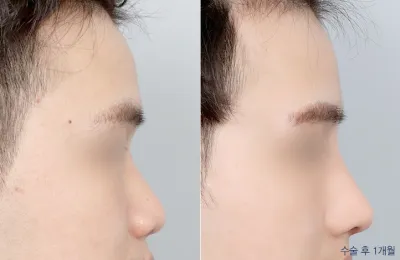Before & After