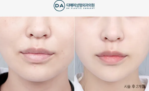 Before/After
