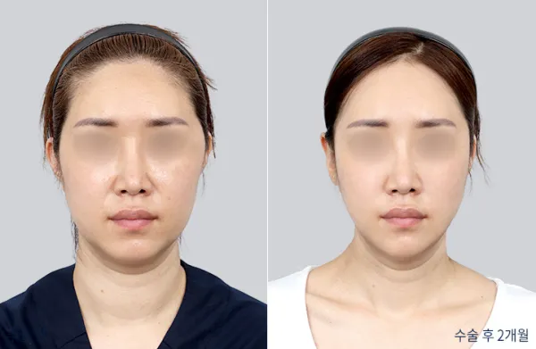 Before/After