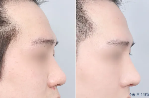Before/After