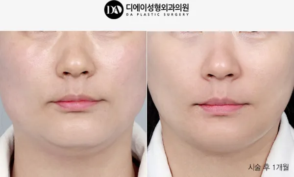 Before/After