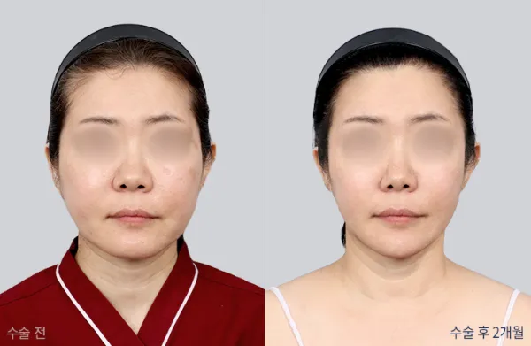 Before/After