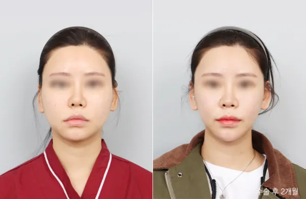 Before/After