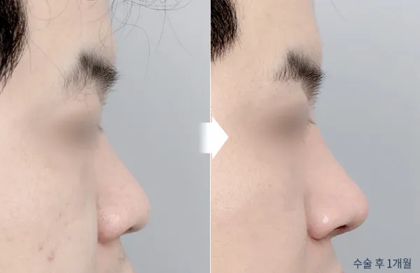 Before/After