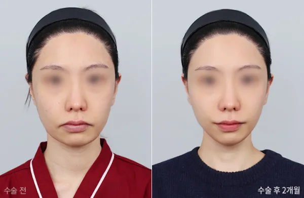 Before/After