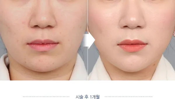 Before/After