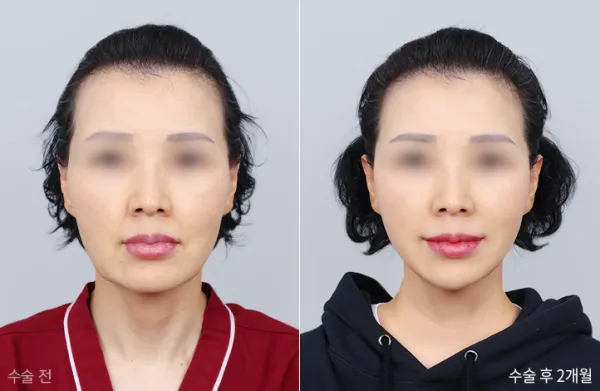 Before/After